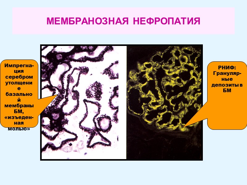 МЕМБРАНОЗНАЯ НЕФРОПАТИЯ Импрегна- ция серебром утолщение базальной мембраныБМ, «изъеден- ная молью»  РНИФ: Грануляр-